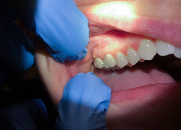 Best Emergency Gum Treatment in Brenham, TX
